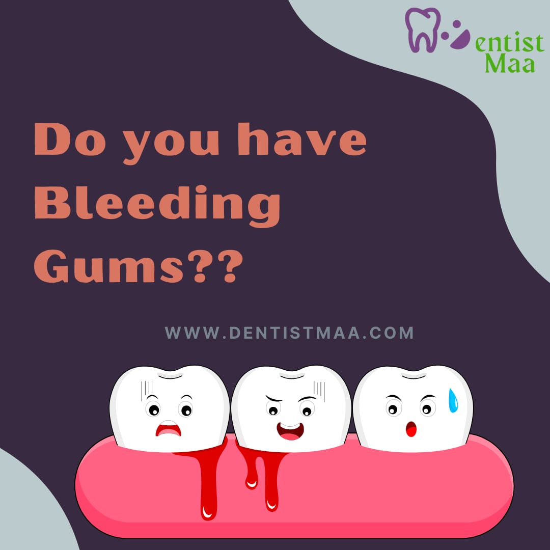 There are a lot of causes of bleeding gums, but most common being Gingival Inflammation as we call it. It is the inflammation of the gingiva i.e. your gums, which might have been caused by improper oral hygiene. A layer of plaque (debris and the bacteria) gets deposited on the surface of our teeth which causes the inflammation of the gums. This leads to redness, bleeding, swelling and tenderness in the gums. This is the early sign of gum disease i.e. Gingivitis.