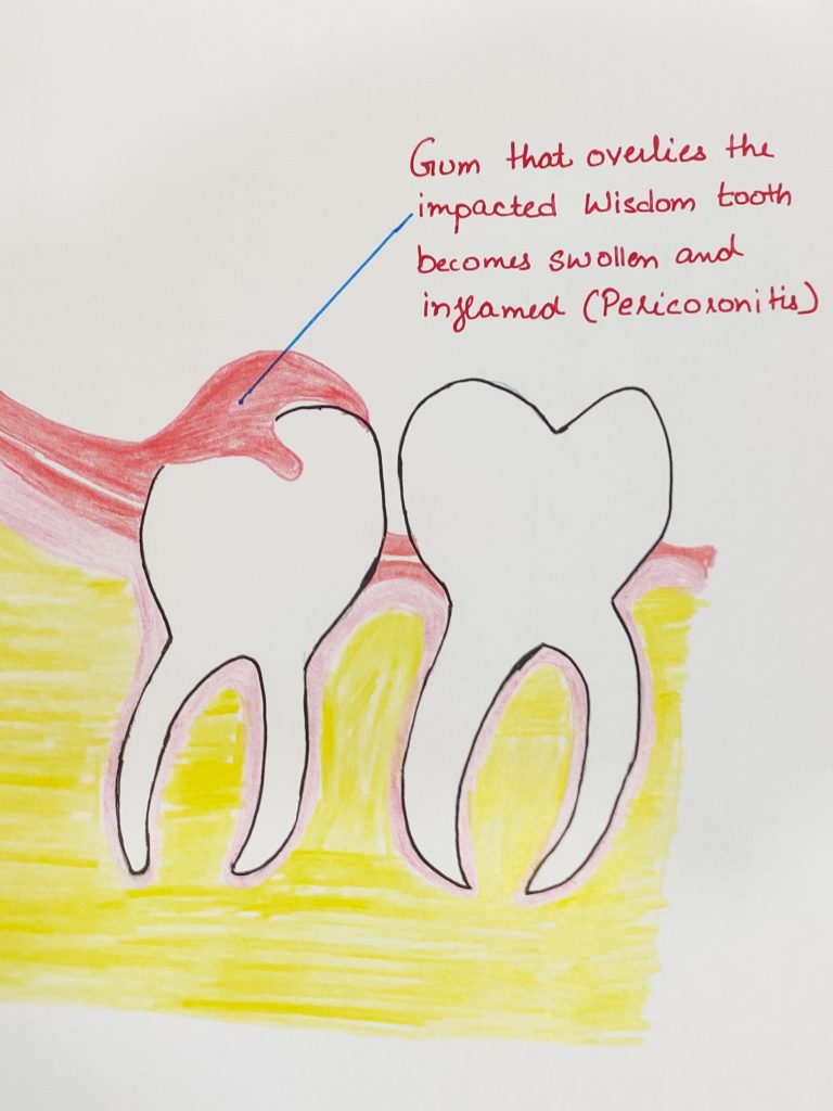 Pericoronitis, infection in the soft tissue overlying the wisdom teeth