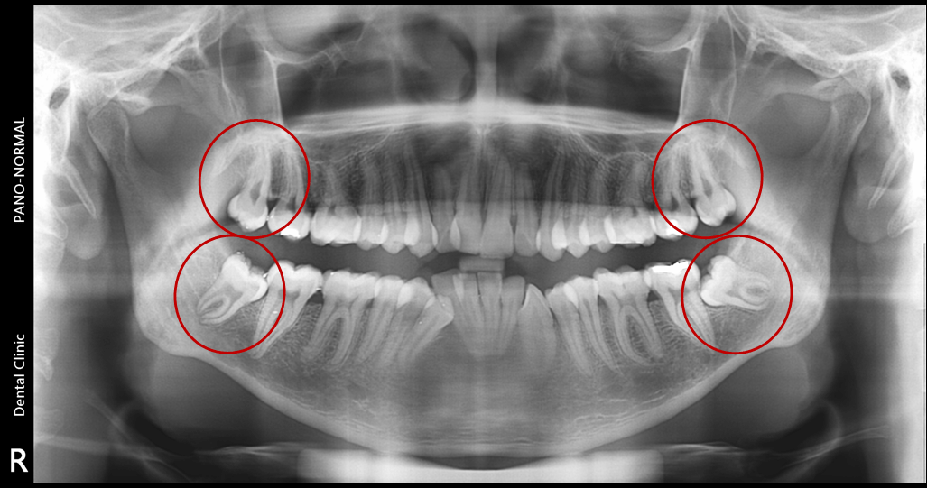 dental now panorama | OPG Xray showing the wisdom teeth