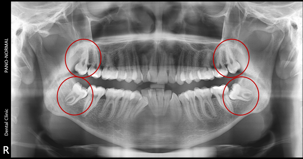 Everything you need to know about the Wisdom Teeth for better oral ...