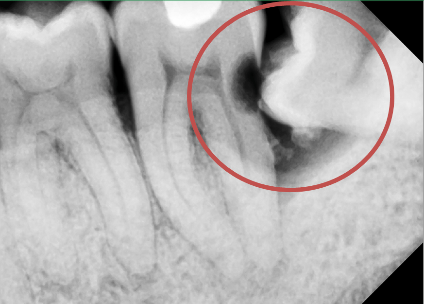 xray showing wisdom tooth causing cavity in adjacent tooth