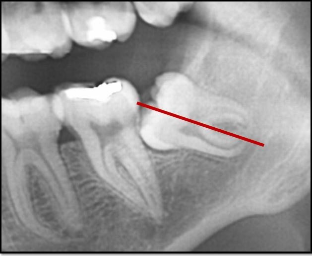 xray of impacted wisdom tooth