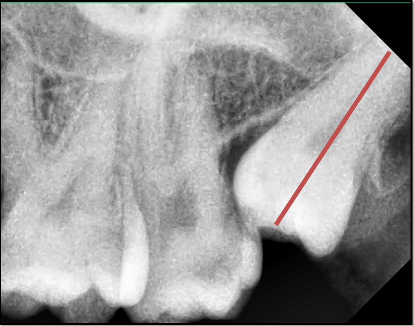 xray of impacted wisdom tooth