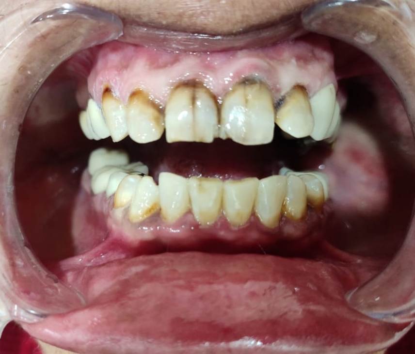 fluorisis stains, discoloured teeth , chromogenic bacteria, black stains, kids teeth