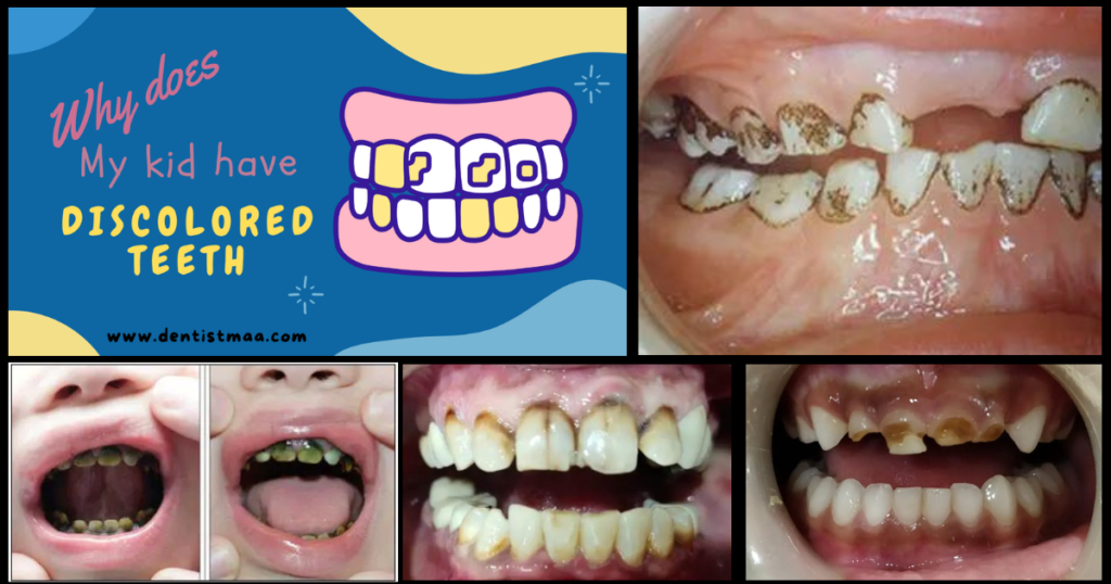 discoloured teeth , chromogenic bacteria, black stains, kids teeth