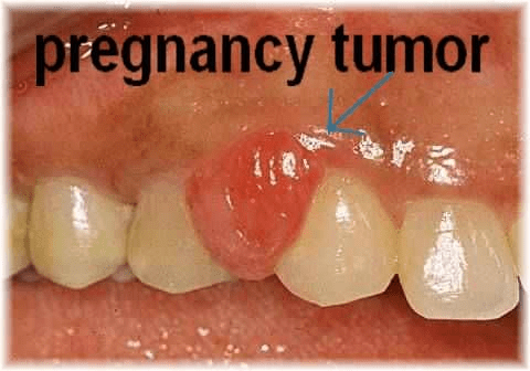 pregnancy tumor or pregnancy gingivitis