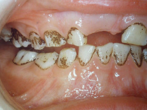 staining due to Chromogenic bacteria on kids teeth, discoloured teeth , chromogenic bacteria, black stains, kids teeth