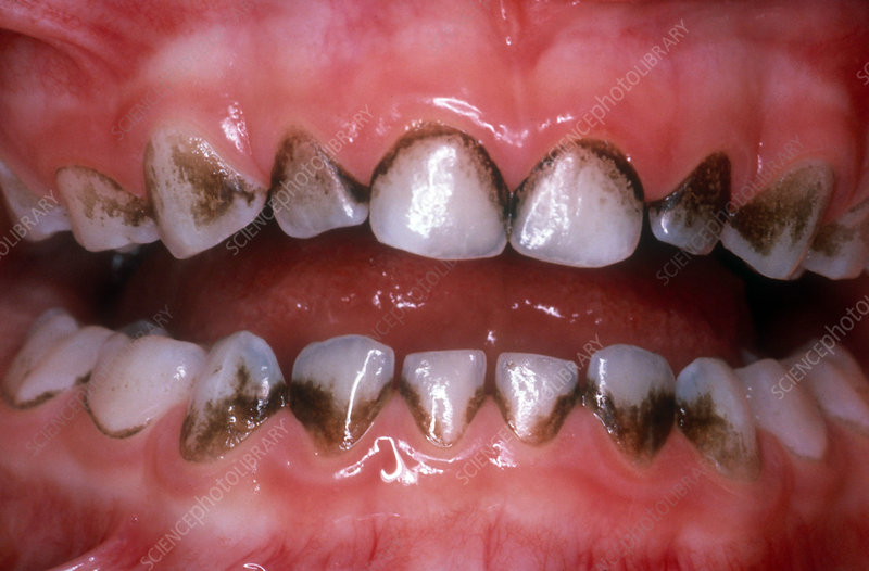 black iron stains on teeth, discoloured teeth , chromogenic bacteria, black stains, kids teeth