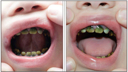 hyperbilirubinemia green teeth,discoloured teeth , chromogenic bacteria, black stains, kids teeth