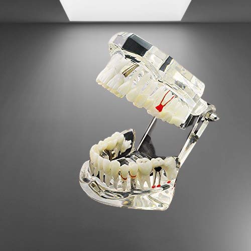 All In One Study Model, Feature - Dental implants, Crown and bridge, Implant-supported bridge, Tooth avulsion, Abfraction Root canal Caries Periapical