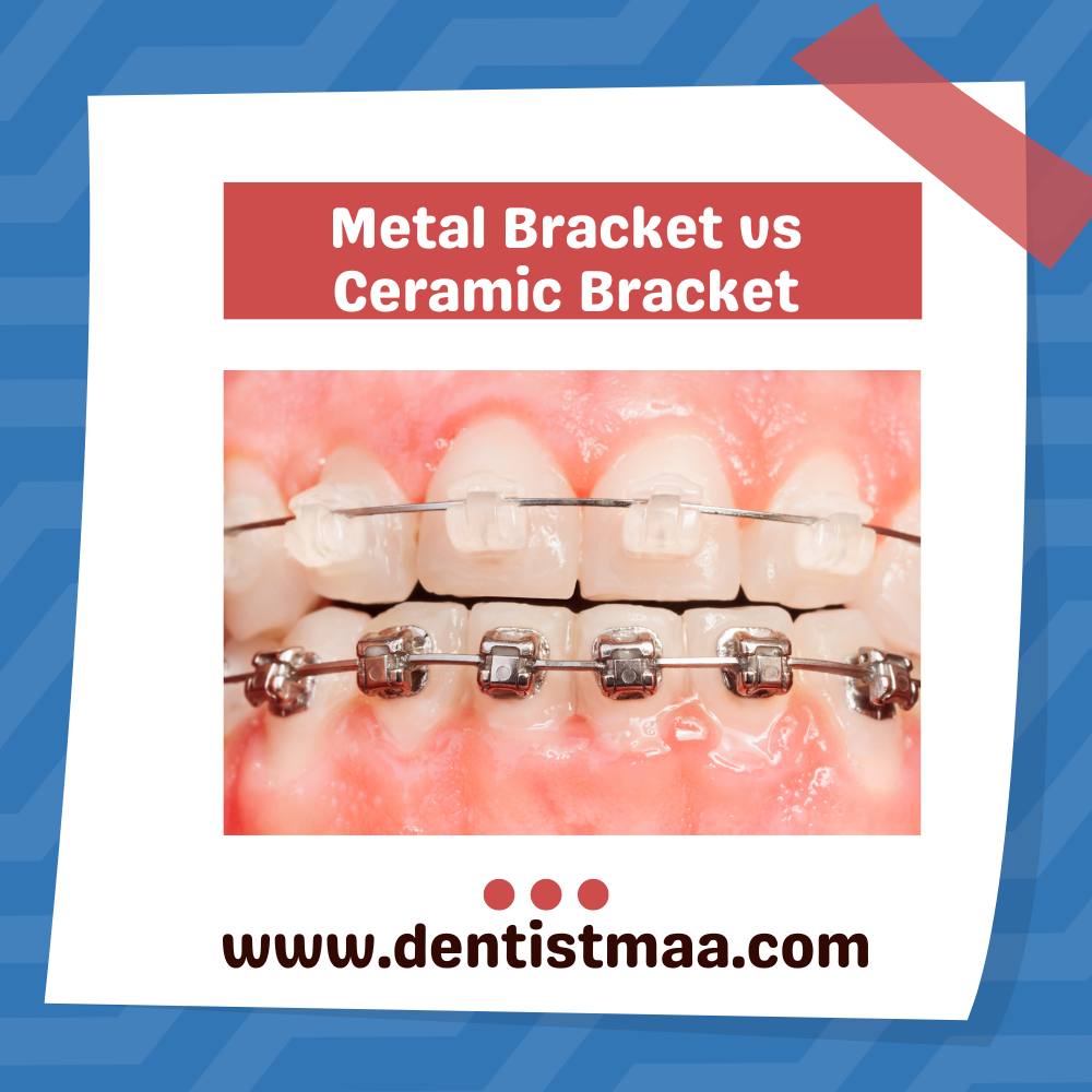 Metal Bracket vs Ceramic Bracket