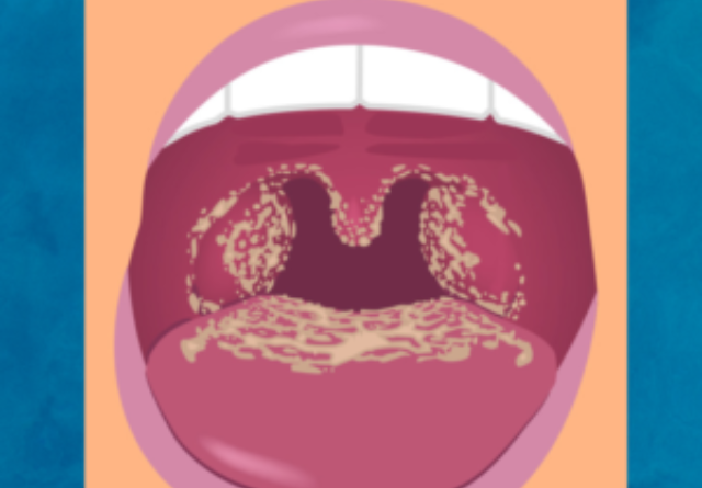 oral Thrush, Oral Candidiasis