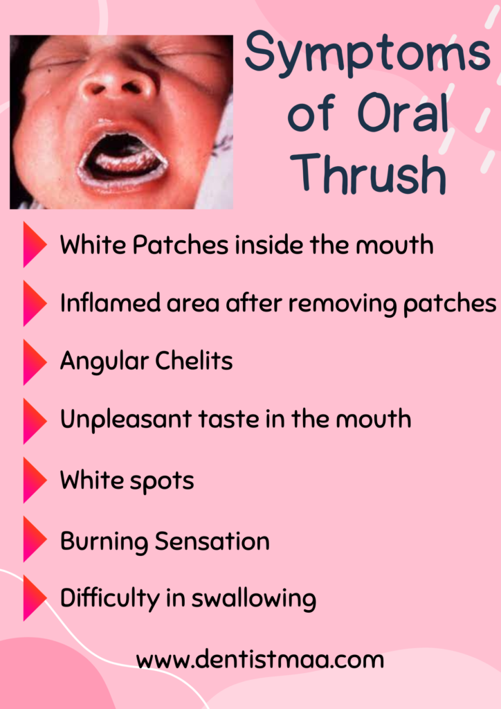 oral thrush, oral candidiasis, thrush, symptoms of oral thrush