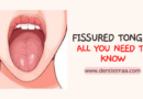 fissured tongue, fissured tongue causes, fissured tongue treatment