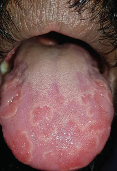 fissured tongue causes, fissured tongue treatment
