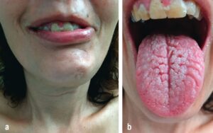 Fissured Tongue associated with Merkelsson- Rosenthal Syndrome, fissured tongue causes, fissured tongue treatment, crack in middle of tongue