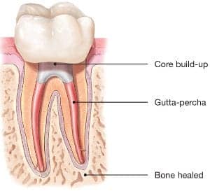 root canal treated tooth with core build up and crown, root canal treatment
