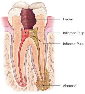 infected tooth, infected pulp, decayed tooth