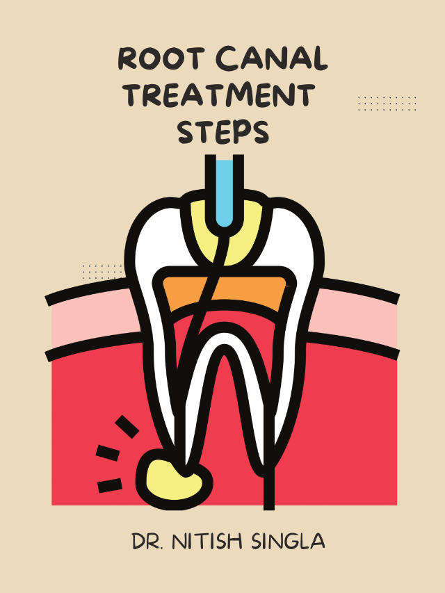 root canal treatment steps, steps of root canal treatment