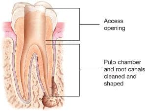 access opening and cleaning of root canal system by dentist while doing root canal treatment, steps of root canal treatment, root canal treatment steps