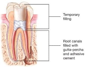 root canal treated tooth with gutta percha and temporary restoration