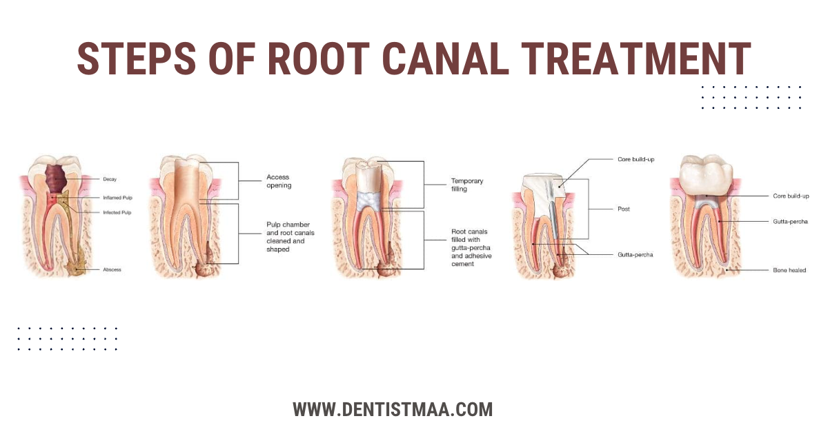 Endodontist in mohali, root canal specialist in mohali, dentist in mohali, root canal treatment steps