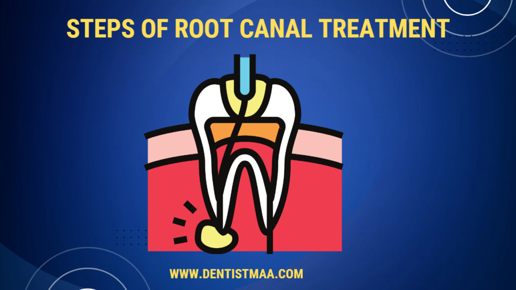 root canal treatment steps, steps of root canal treatment, root canal treatment steps with pictures