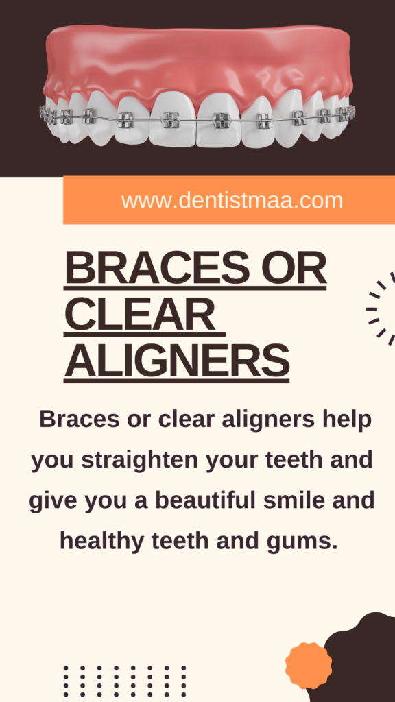 braces, invasiligns, clear aligners, teeth, gums, straight teeth, crocked teeth