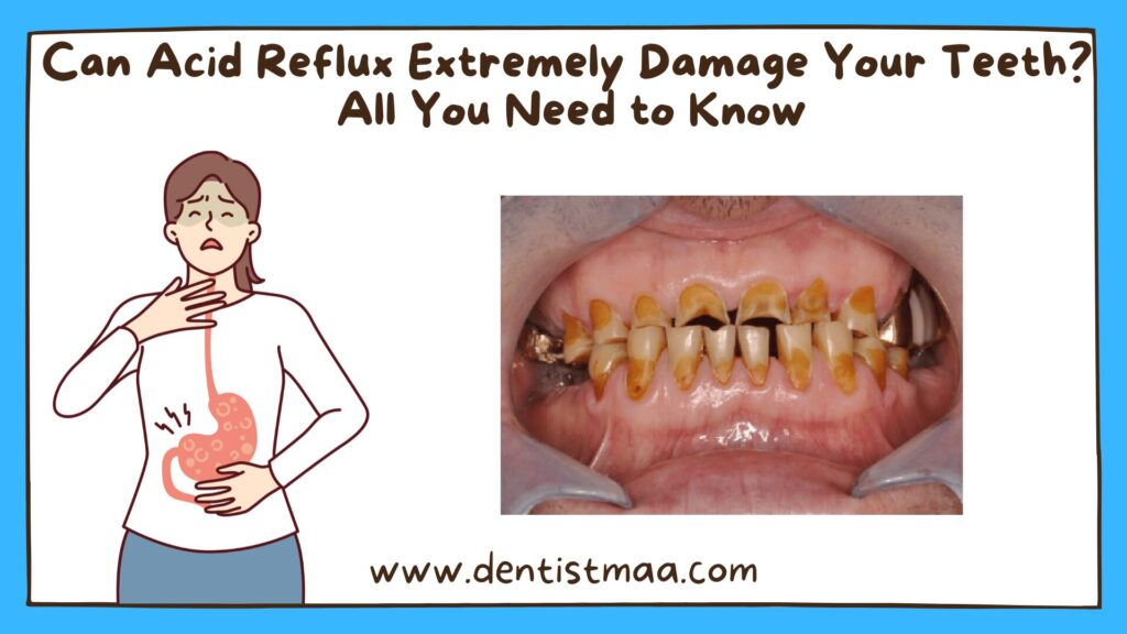 Acid Reflux, GERD, Gastroesophageal reflux disease, tooth erosion, teeth erosion