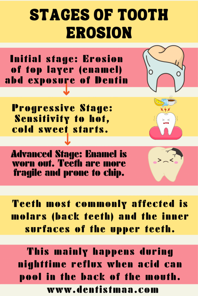  acid reflux, tooth erosion, enamel, dentin, pulp, erosion, gerd, teeth, tooth,